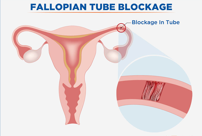 Blocked Fallopian Tubes Treatmen